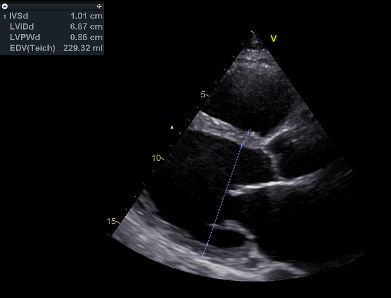Gedilateerde cardiomyopathie. Normotroof en matig gedilateerd linker ventrikel spierdikte < 12 mm, eind-diastolische LV diameter > 50 mm).