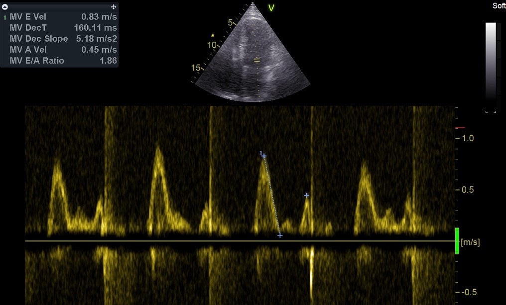 Mitralisklepinflowpatroon (met Doppler) en beweging van de laterale mitralisklepannulus (E’, met TDI). Verhoogde LV drukken met E/A ratio > 1.5, verkorte deceleratietijd ≤ 160 ms, E’ < 8 en E/E’ > 14.