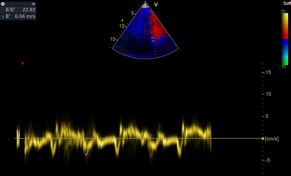 Mitralisklepinflowpatroon (met Doppler) en beweging van de laterale mitralisklepannulus (E’, met TDI). Verhoogde LV drukken met E/A ratio > 1.5, verkorte deceleratietijd ≤ 160 ms, E’ < 8 en E/E’ > 14.