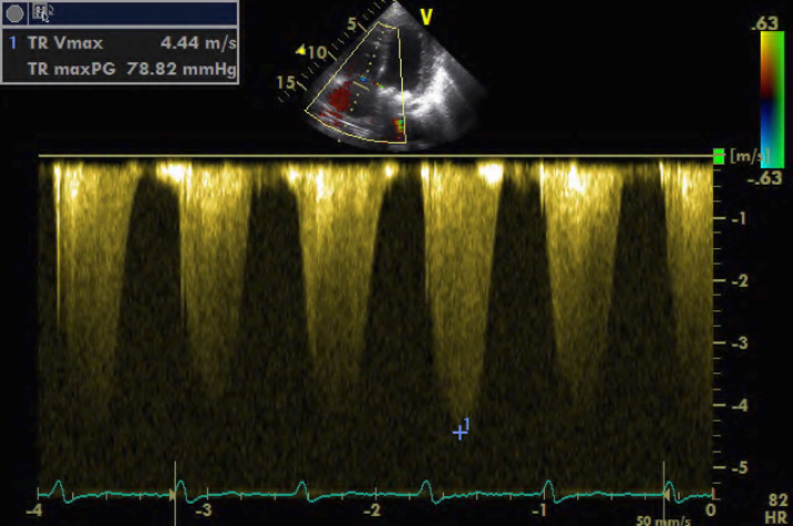 Flowsnelheid door tricuspidalisklepinsufficiëntie (met Doppler) voor meting van de druk in de arteria pulmonalis. Pulmonale hypertensie met piek flowsnelheid > 2,8 m/sec en berekende gradiënt 79 mmHg. Schatting van de pulmonalisdruk is 79 mmHg + CVD.