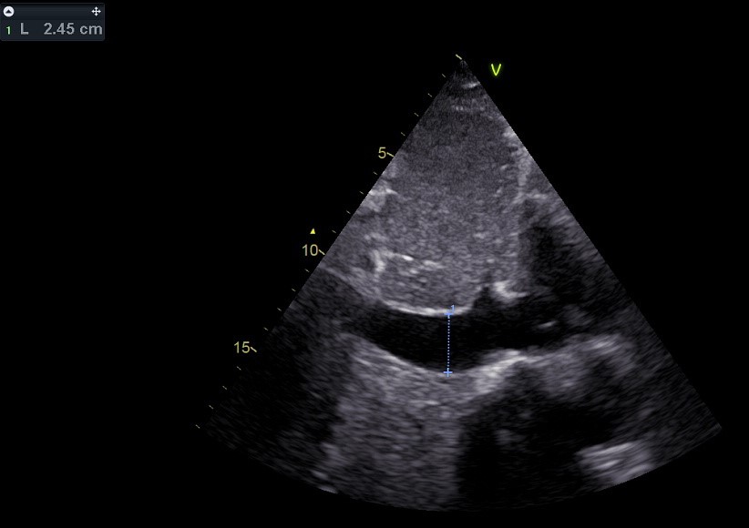 Gedilateerde vena cava inferior, indicatief voor een verhoogde druk in het rechter atrium (centraal veneuze druk, CVD). Indien bewaarde ademhalingsvariatie bij inspiratie wordt CVD geschat op 10 mmHg. Indien verminderde ademhalingsvariatie: CVD 15 mmHg. Indien geen ademhalingsvariatie: CVD 20 mmHg.