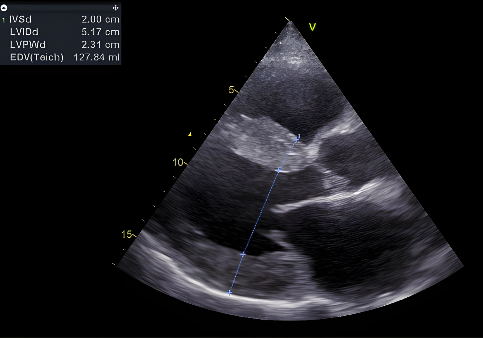 Typisch beeld van cardiale amyloïdose. Uitgesproken diffuse, concentrische LV hypertrofie (septum 20 mm, posterior wand 23 mm – normaal < 12 mm). Ook is er rechter ventrikel hypertrofie en een gedilateerd linker atrium.