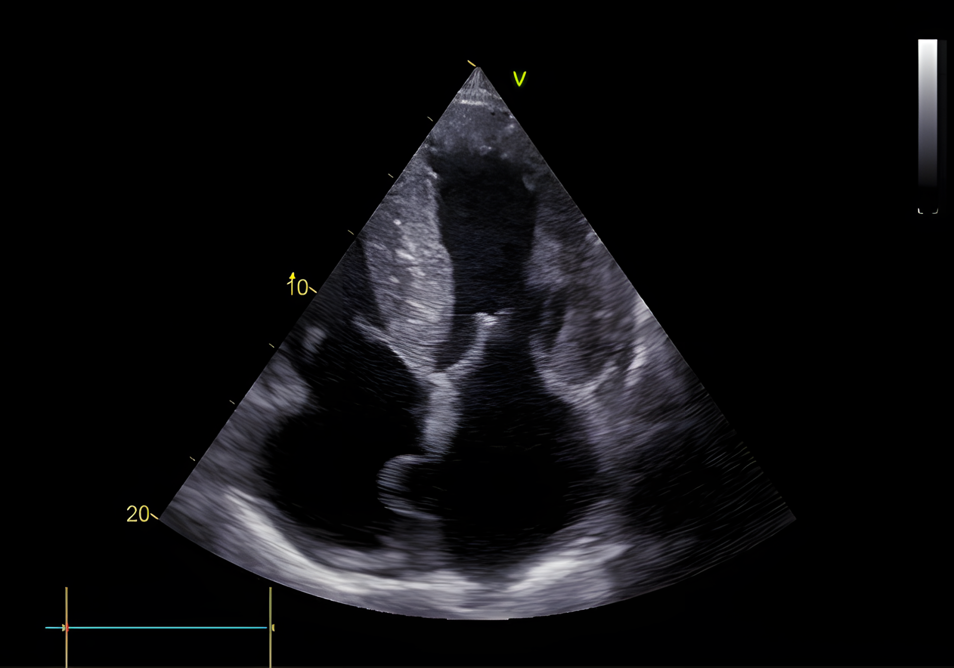Typisch beeld van cardiale amyloïdose. Uitgesproken diffuse, concentrische LV hypertrofie (septum 20 mm, posterior wand 23 mm – normaal < 12 mm). Ook is er rechter ventrikel hypertrofie en een gedilateerd linker atrium.