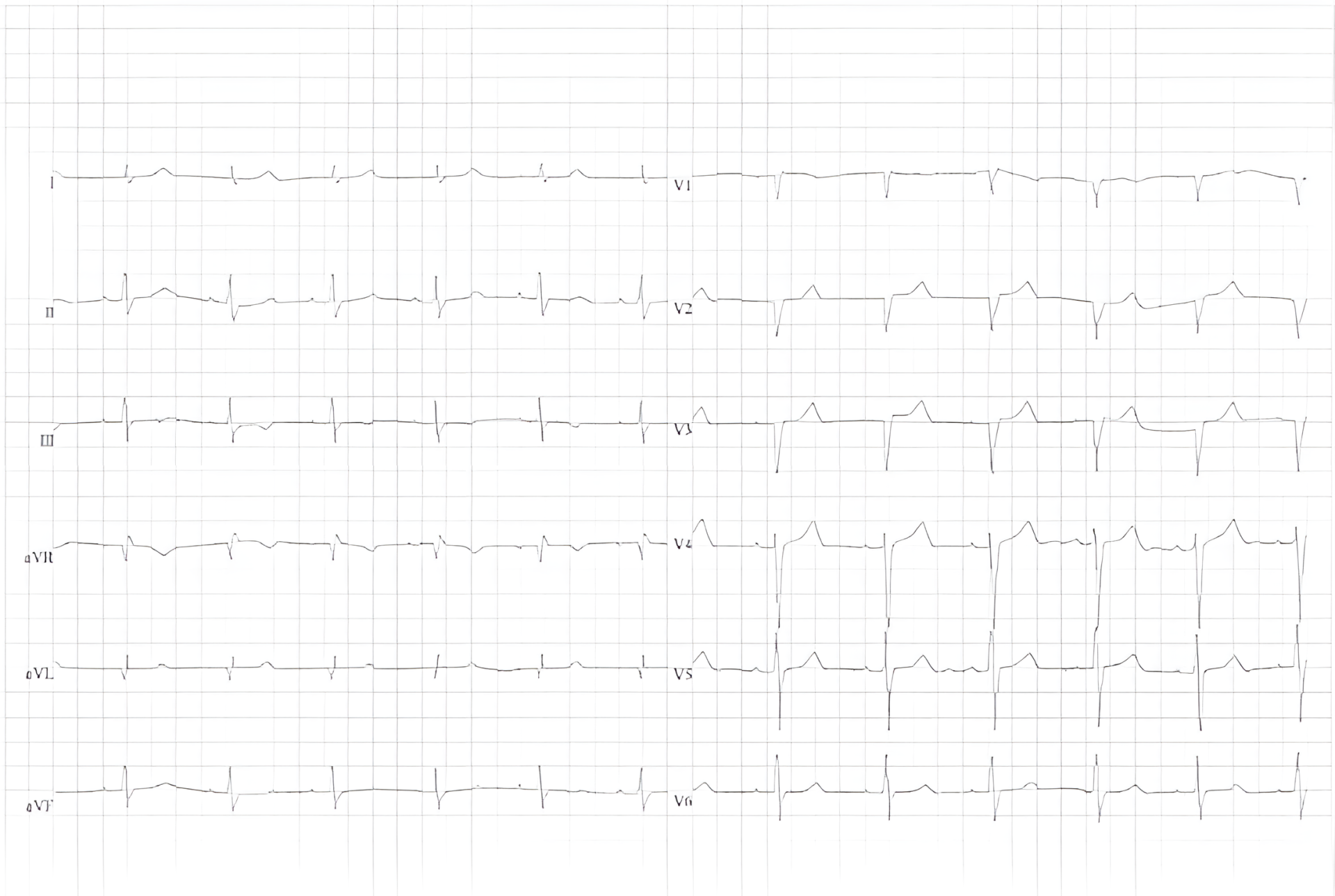 ECG van een patiënt met cardiale amyloïdose. Lage voltages van het QRS complex in de perifere afleidingen. Pseudo-infarctpatroon in afleidingen V1-3 met trage R-progressie.