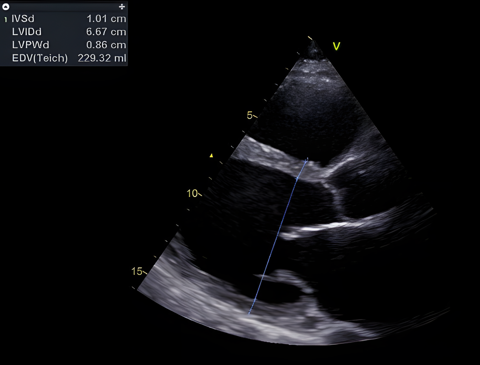 Gedilateerde cardiomyopathie. Normotroof en matig gedilateerd linker ventrikel (spierdikte < 12 mm, eind-diastolische LV diameter > 50 mm).