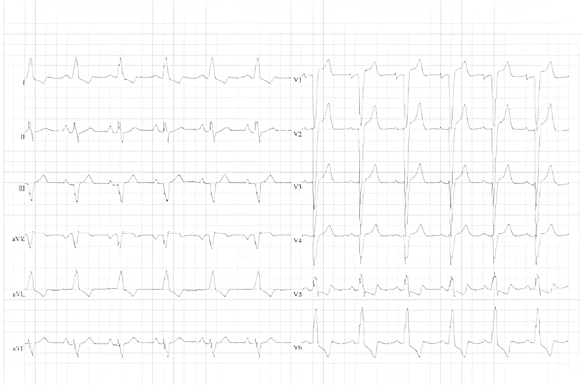 ECG van een patiënt met een hypertrofe cardiomyopathie. LV strainpatroon met negatieve T-toppen in afleiding V4-6. Linker bundeltakblok.