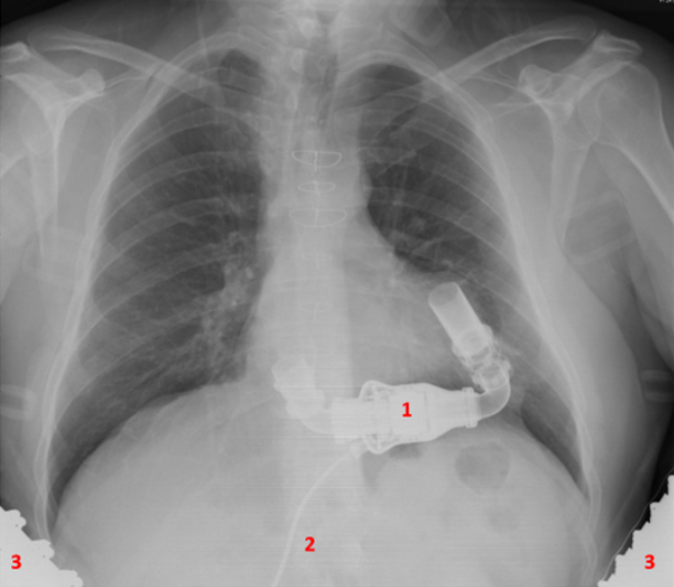 LVAD, left ventricular assist device. Type: Heartmate II. 1. Pomp, 2. de driveline (de kabel die de ingeplante pomp verbindt met de controller en de uitwendige batterijen), 3. Uitwendige batterijen.