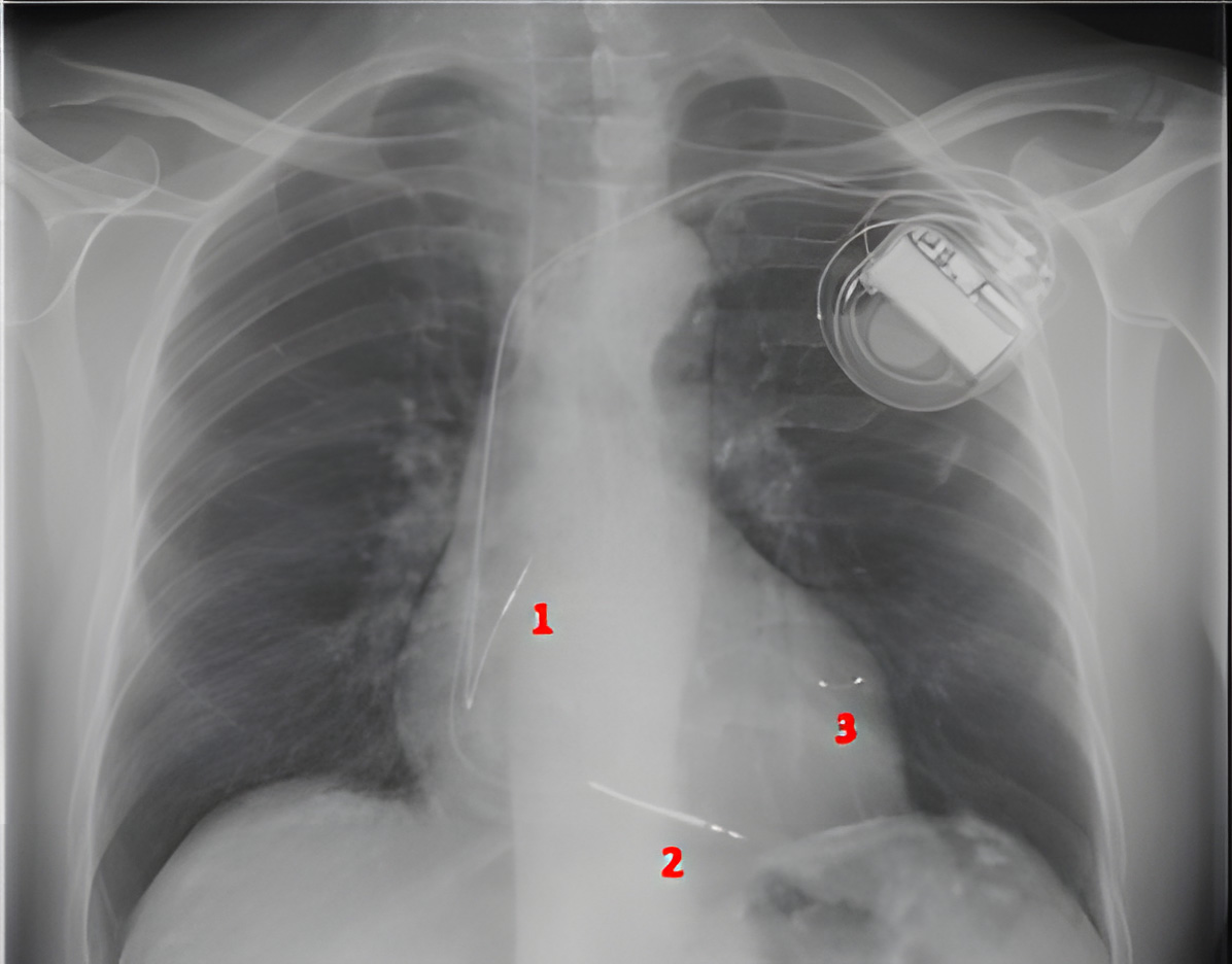 CRT-D device met 3 leads: 1. Rechter atrium, 2. Rechter ventrikel, 3. Linker ventrikel (via de sinus coronarius).