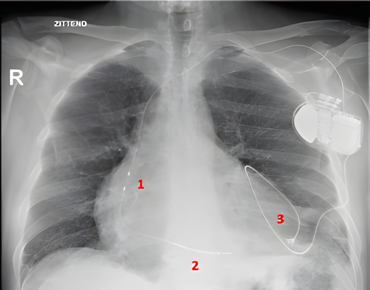 CRT-D device met 2 leads: 1. Rechter atrium: alleen sensing (in de RV lead), 2. Rechter ventrikel, 3. Linker ventrikel (heelkundig epicardiaal geplaatst).