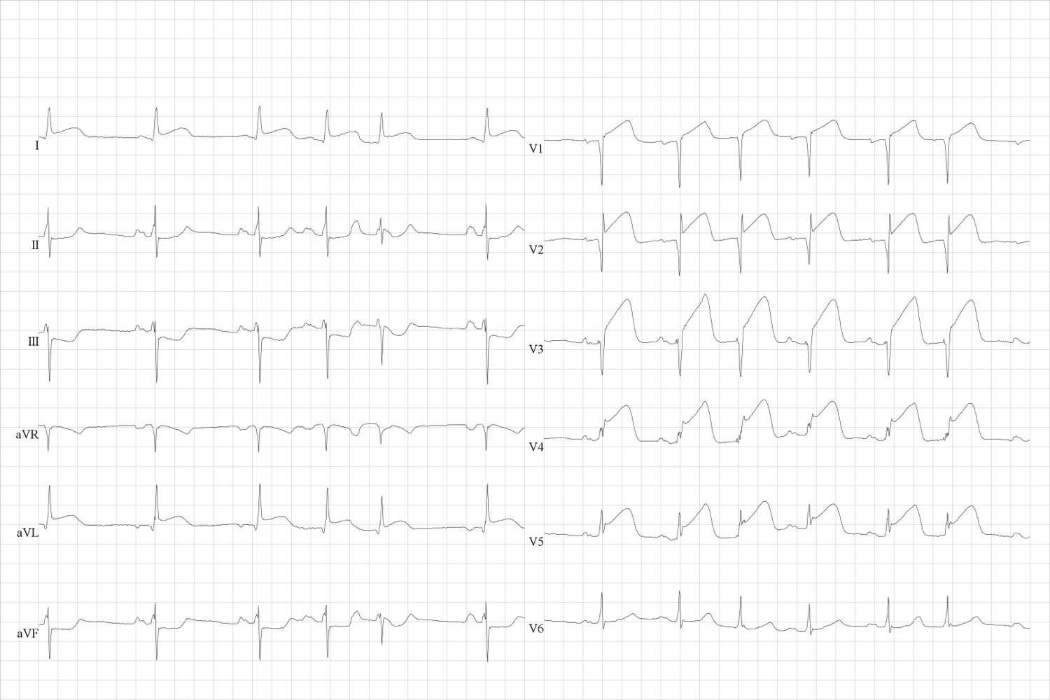 STEMI myocardinfarct. ST-elevaties anterior (V 1 tot 5) met lichte ST-depressie inferior. Occlusie van de LAD.
