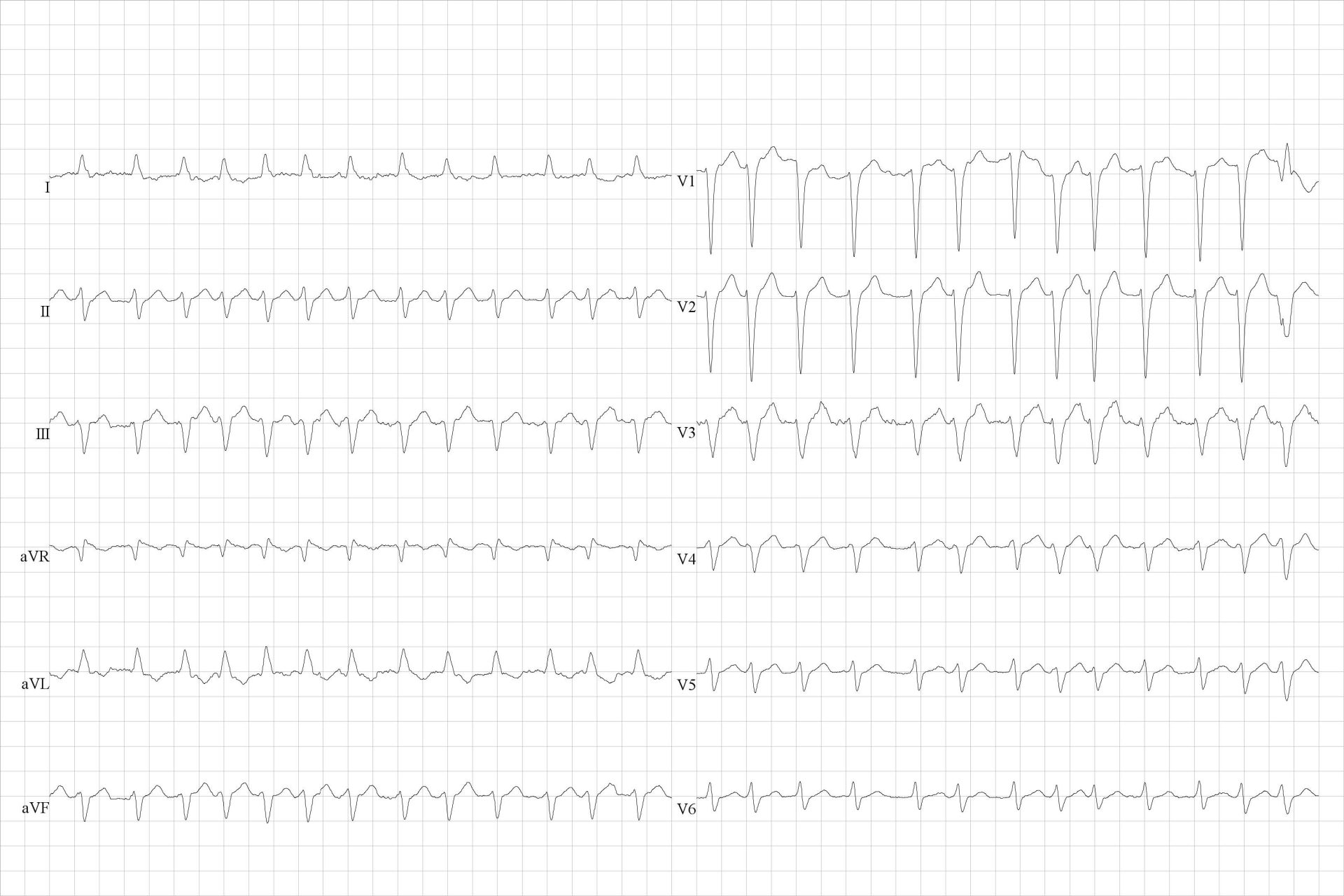 Voorkamerfibrillatie met snel ventriculair antwoord. Linker as en linker anterior hemiblok.