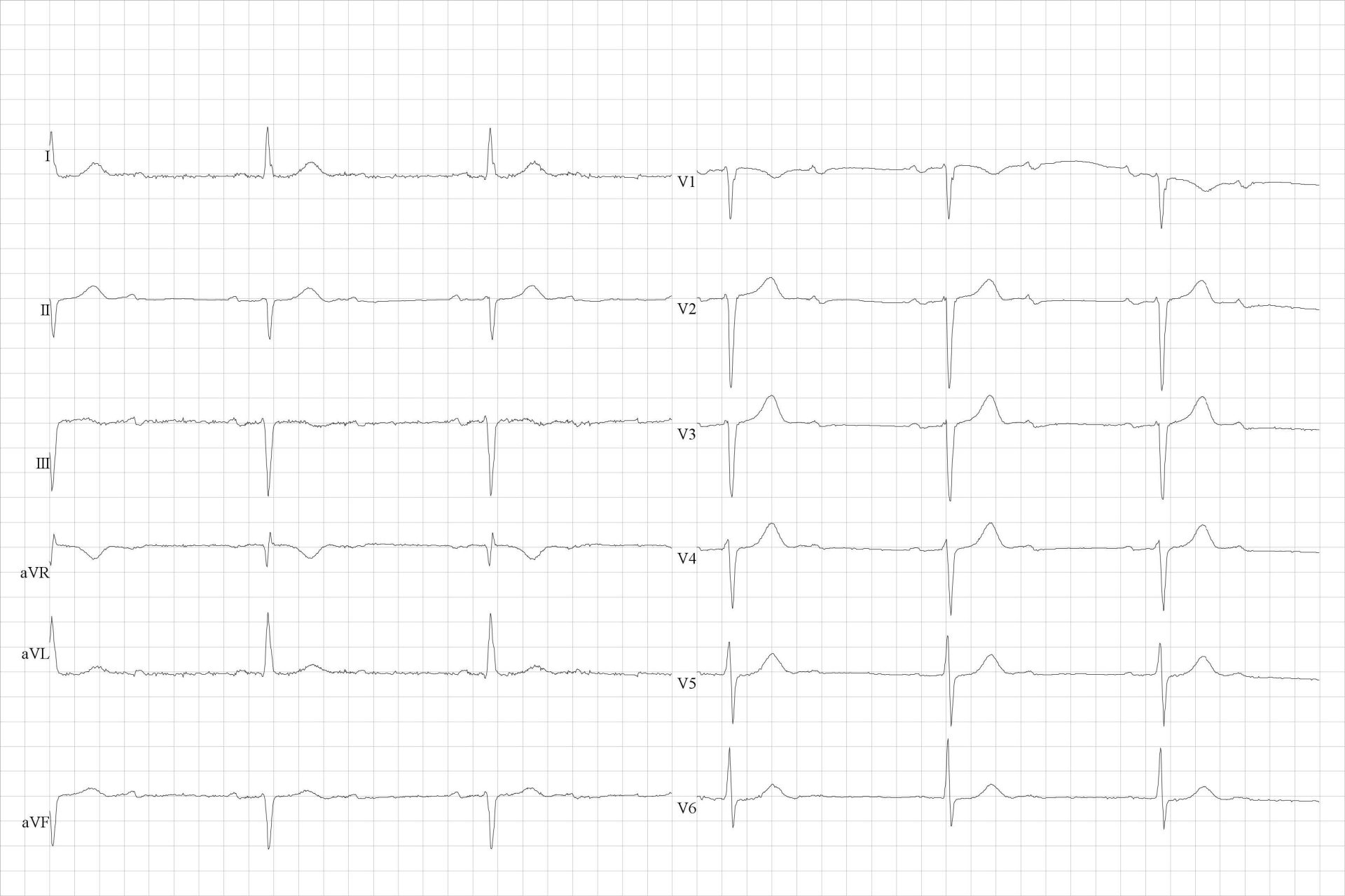 Sinusaal ritme met tweede graads AV-blok met 2 op 1 blok (een P-top wordt afwisselend wel of niet gevolgd door een QRS complex).
