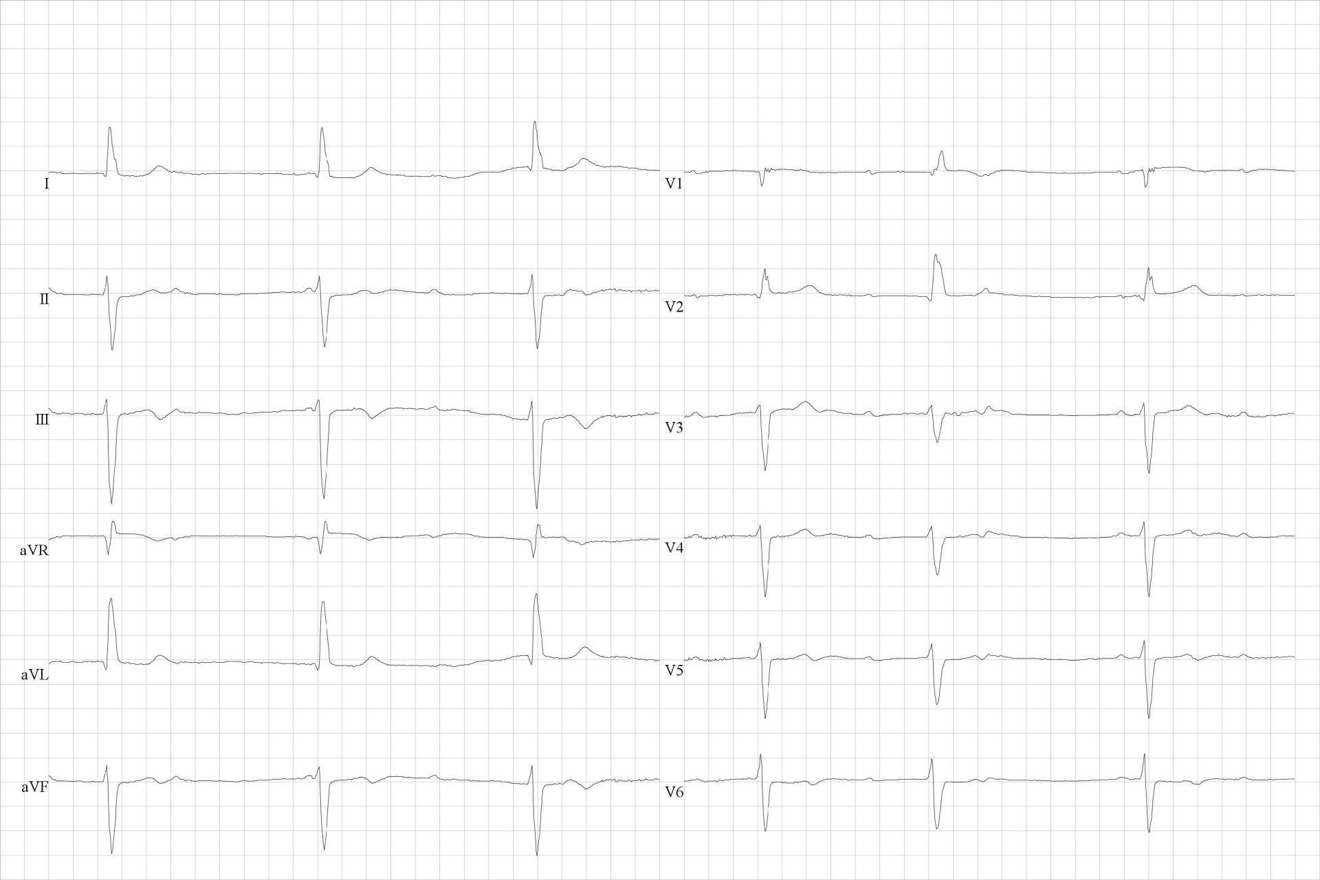 Sinusaal ritme met derde graads AV-blok. P-toppen worden niet gevolgd door een QRS complex. Er is AV-dissociatie met een traag ventriculair escape ritme aan 33 per minuut met rechter bundeltakblok morfologie.