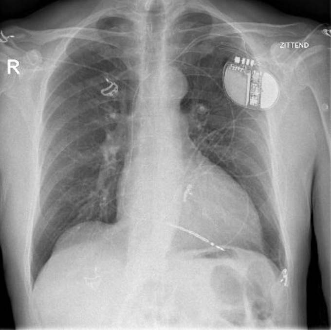 VVI-ICD
