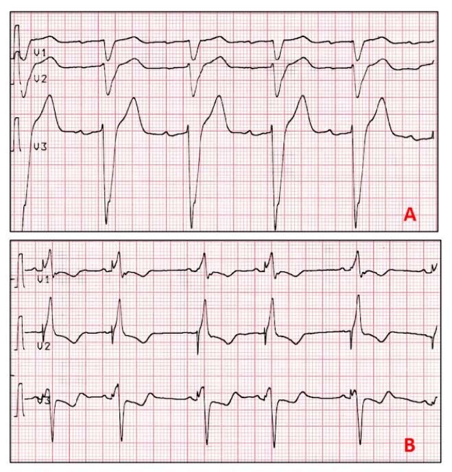 A. voor CRT-implantatie is er een linker bundeltakblok met negatief  QRS-complex in V1-2. B. na CRT-implantatie wordt het QRS-complex smaller en positief in V1-2.