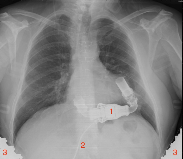 LVAD, left ventricular assist device. Type: Heartmate II. 1. Pomp, 2. de driveline (de kabel die de ingeplante pomp verbindt met de controller en de uitwendige batterijen), 3. Uitwendige batterijen.