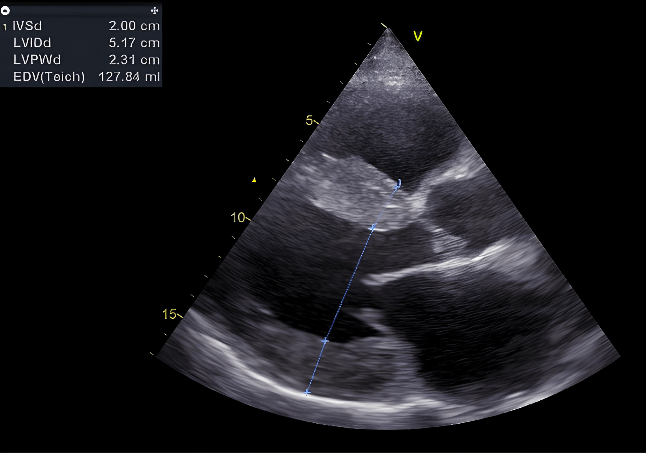 Image typique de l'amylose cardiaque. Hypertrophie ventriculaire gauche prononcée, diffuse et concentrique (septum 20 mm, paroi postérieure 23 mm - normale < 12 mm). On observe également une hypertrophie du ventricule droit et une dilatation de l'oreillette gauche.