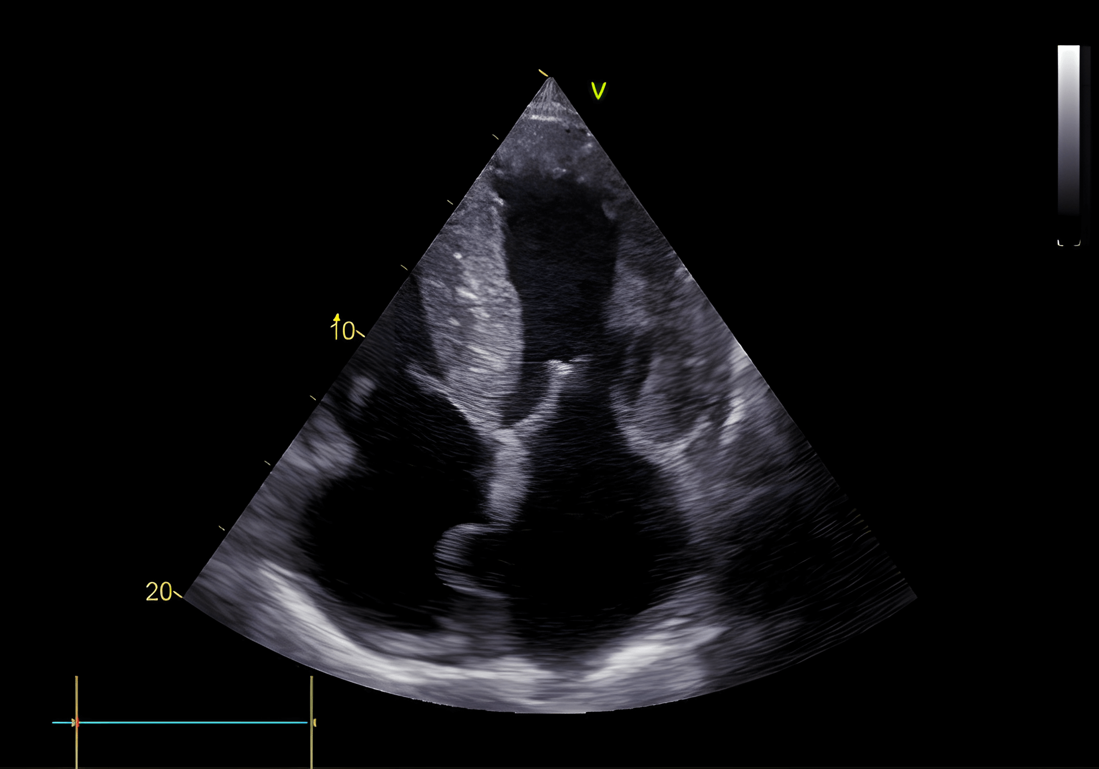Typical picture of cardiac amyloidosis. Pronounced diffuse, concentric LV hypertrophy (septum 20 mm, posterior wall 23 mm - normal < 12 mm). There is also right ventricular hypertrophy and a dilated left atrium.
