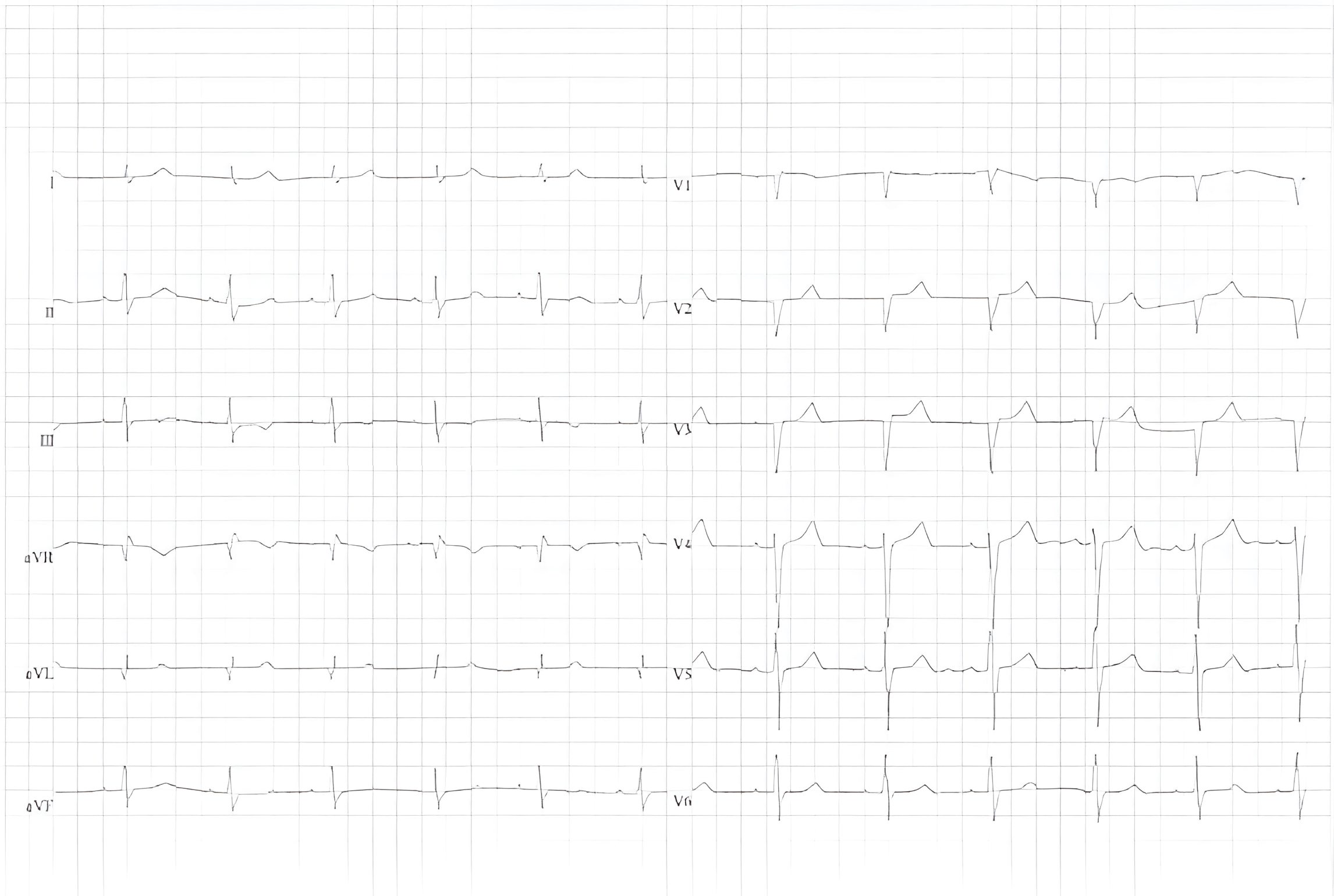 ECG of a patient with cardiac amyloidosis. Low voltages of the QRS complex in the peripheral leads. Pseudo-infarction pattern in leads V1-3 with slow R progression.