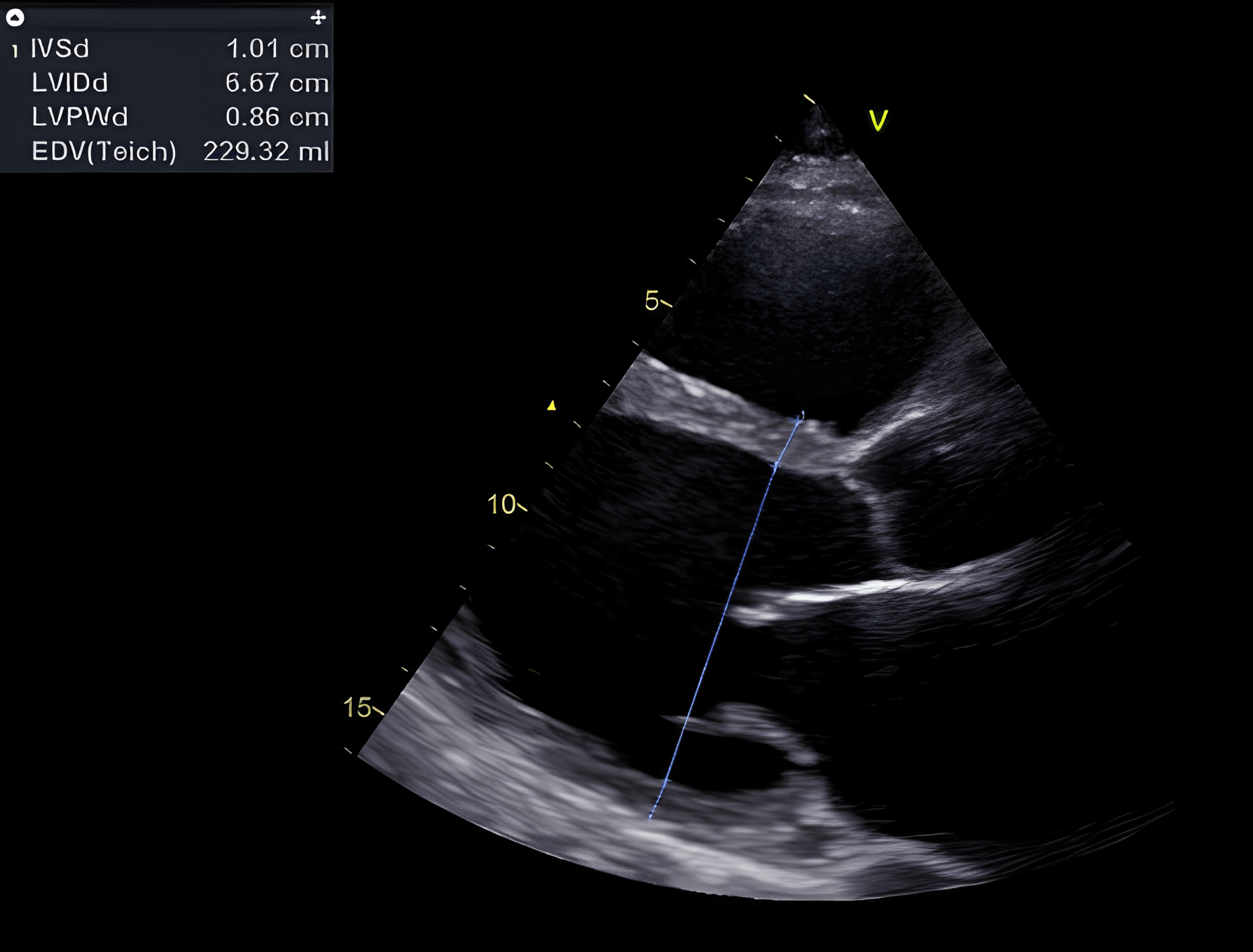 Dilated cardiomyopathy. Normotrophic and moderately dilated left ventricle (muscle thickness < 12 mm, end-diastolic LV diameter > 50 mm).