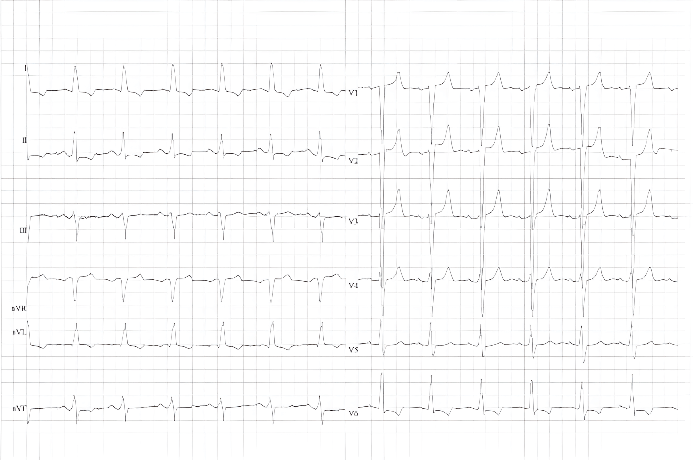 ECG d'un patient atteint de cardiomyopathie dilatée. Bloc hémorragique antérieur gauche à bloc de branche gauche léger avec pointes T non spécifiques et légèrement négatives en inférolatéral.