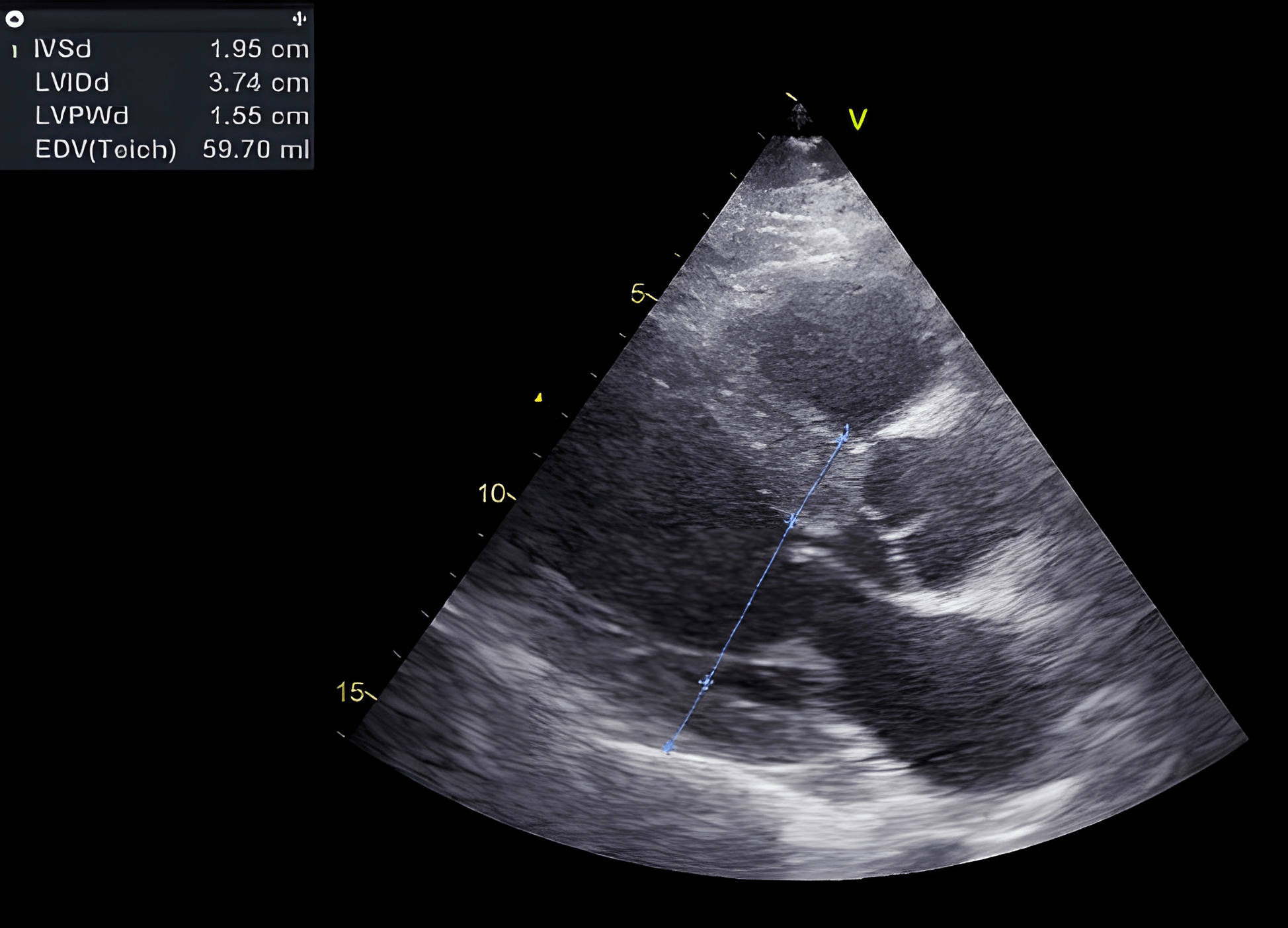 Hypertrophie asymétrique du ventricule gauche avec principalement un septum interventriculaire épaissi (19,5 mm, normal < 12 mm). La paroi postérieure est nettement moins hypertrophiée.