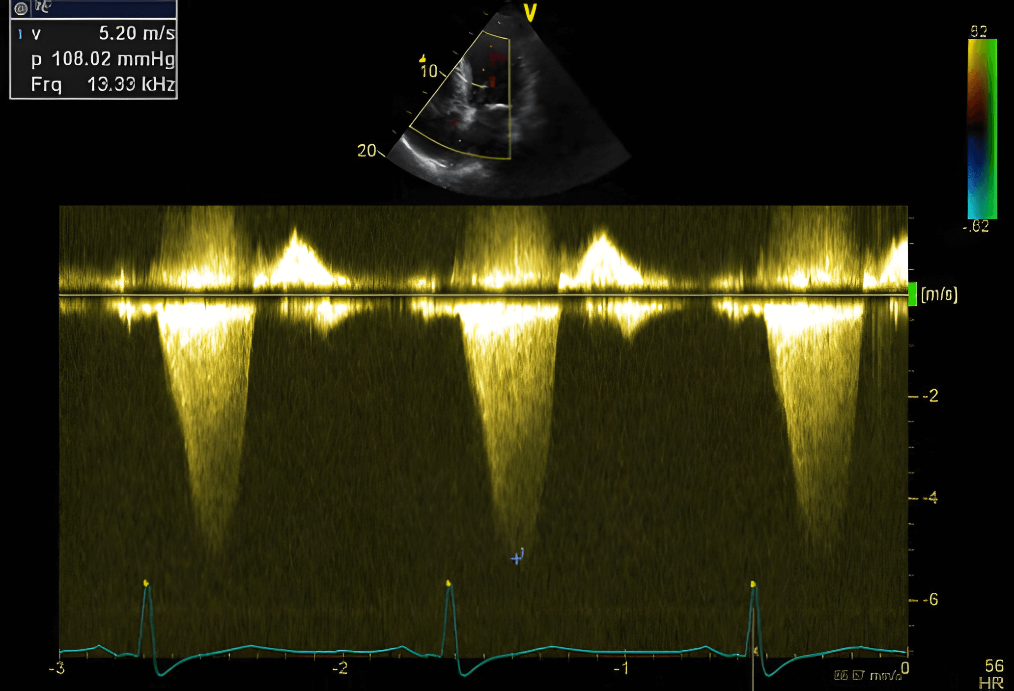 Obstructive hypertrophic cardiomyopathy. Increased gradient across the left ventricular outflow tract (LVOT): 108 mmHg (measured by Doppler, normal < 10 mmHg): LVOT obstruction.