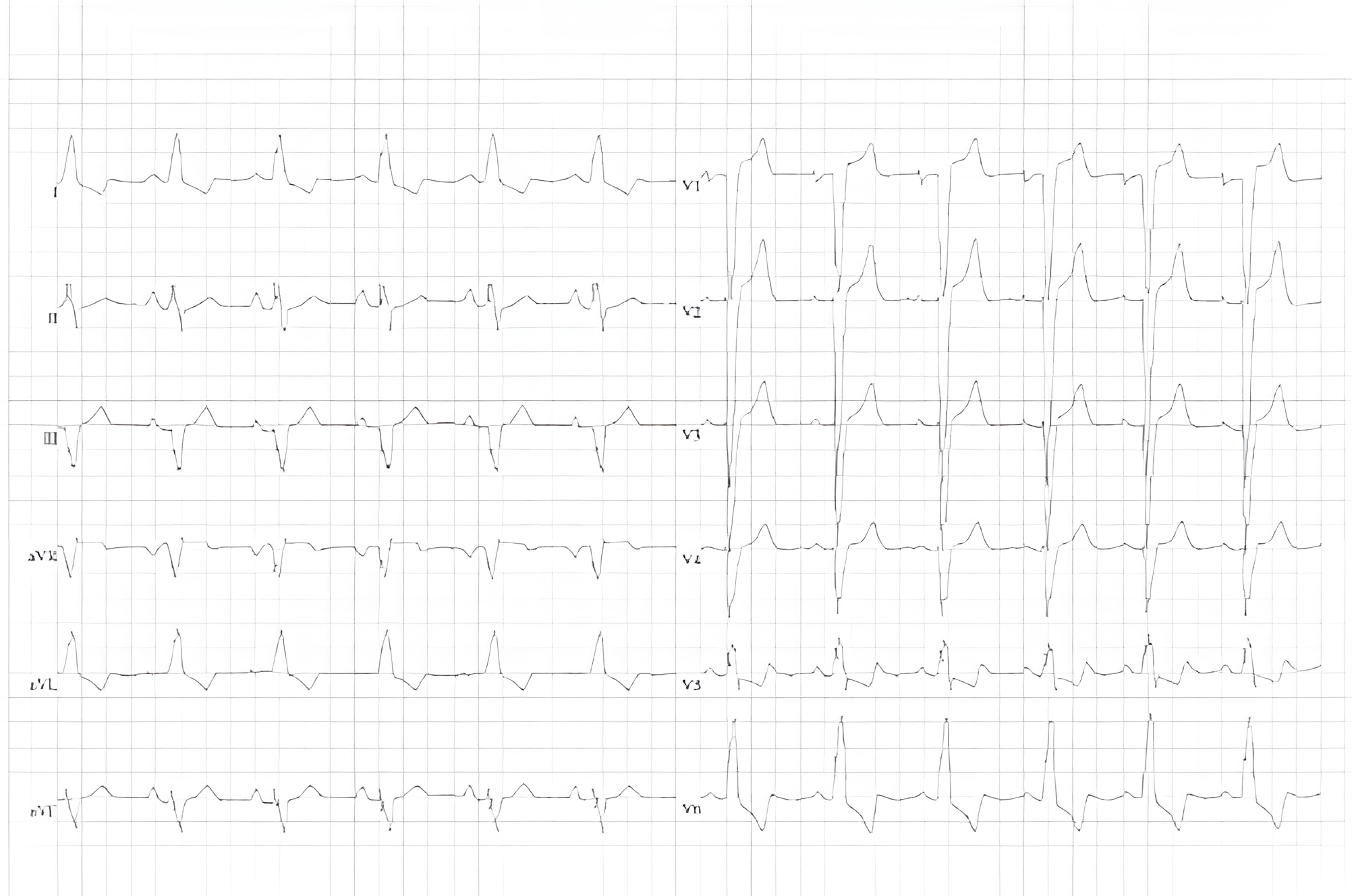 ECG of a patient with hypertrophic cardiomyopathy. LV strain pattern with negative T peaks in leads V4-6. Left bundle branch block.