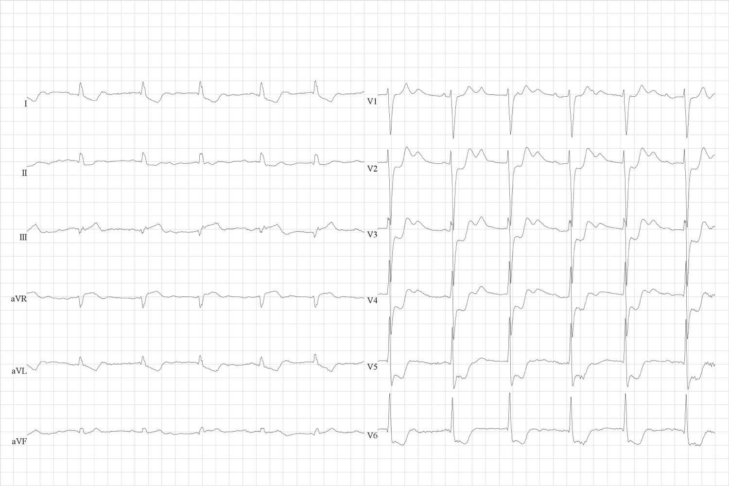 Infarctus du myocarde non STEMI. Dépressions ST antérolatérales (V 2 à 6).
