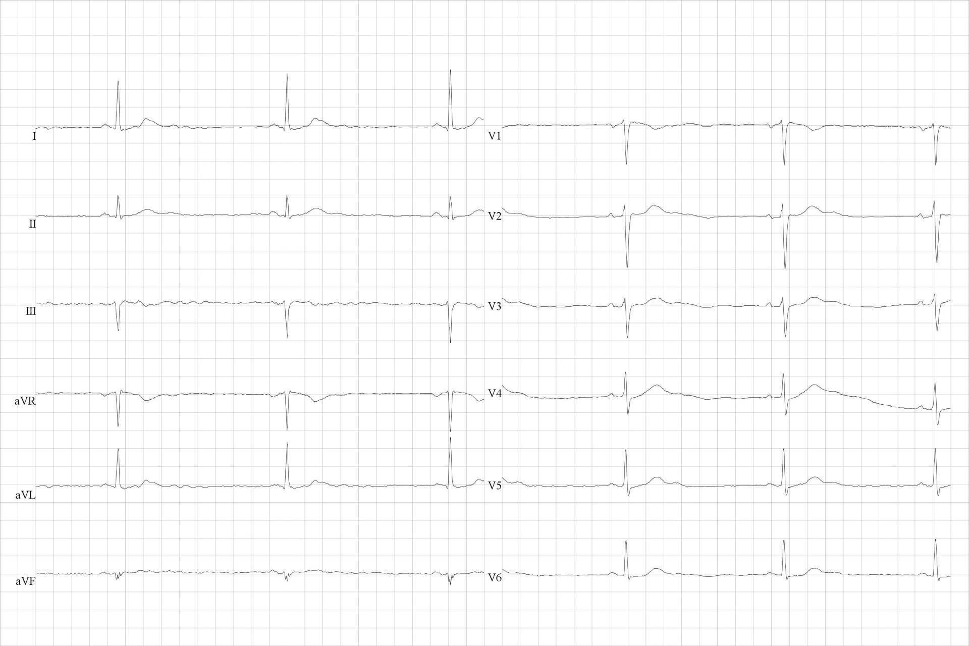 Sinus bradycardia at 34 per minute.