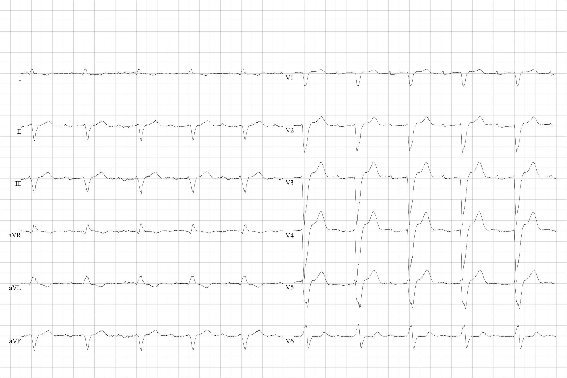 Sinus rhythm with a long first degree AV block (PR interval 380-400 ms) and a left bundle branch block. Each P wave is still followed by a QRS complex.