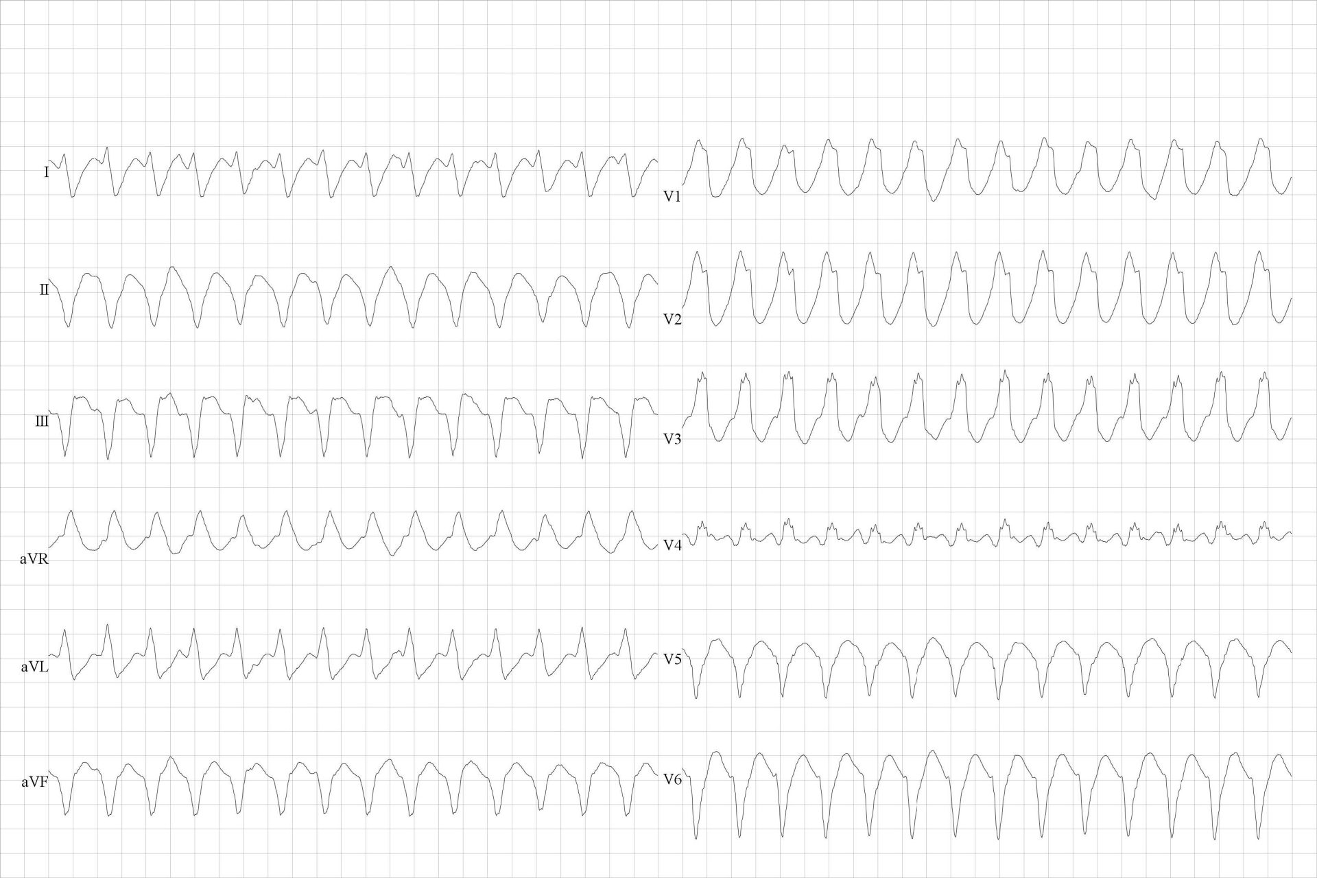 Wide QRS tachycardia. Ventricular tachycardia (VT).